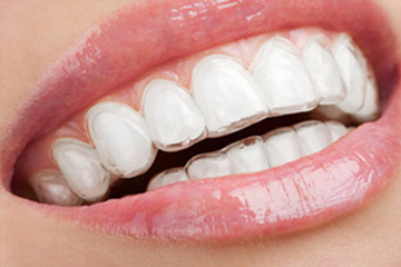 aparelho-invisalign.jpg